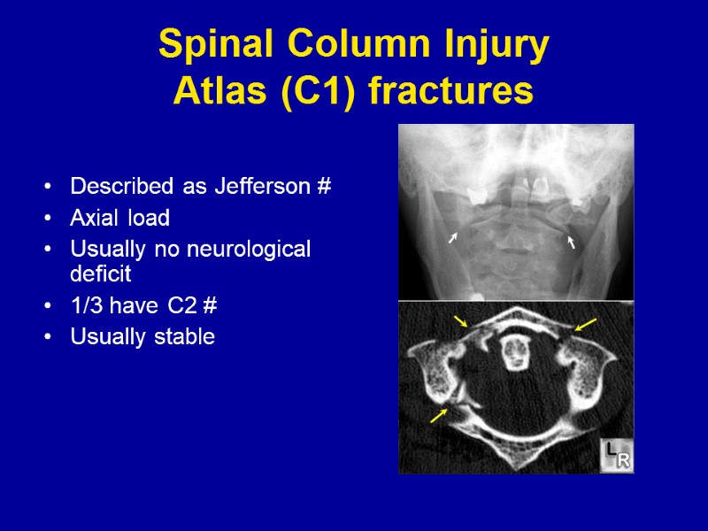 Spinal Column Injury Atlas (C1) fractures Described as Jefferson # Axial load  Usually